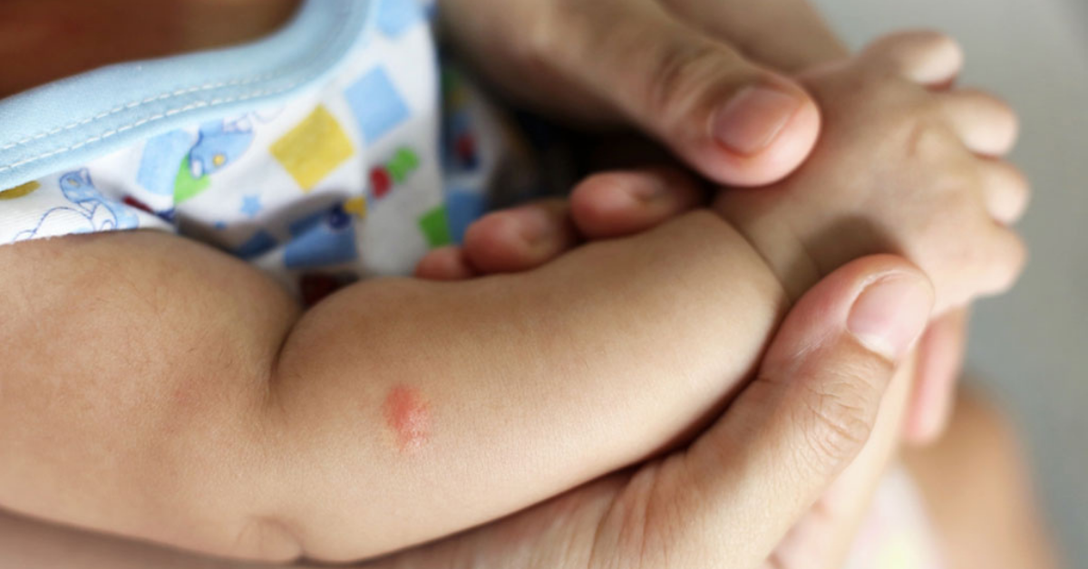 Kako tretirati ubode komaraca kod beba?