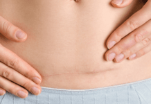 Crijevna flora kod prijevremeno rođene djece i novorođenčadi rođenih carskim rezom